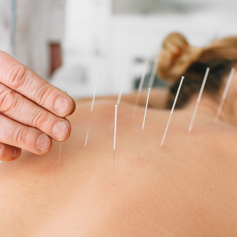 alt= Acupuncture needles in the back of a patient